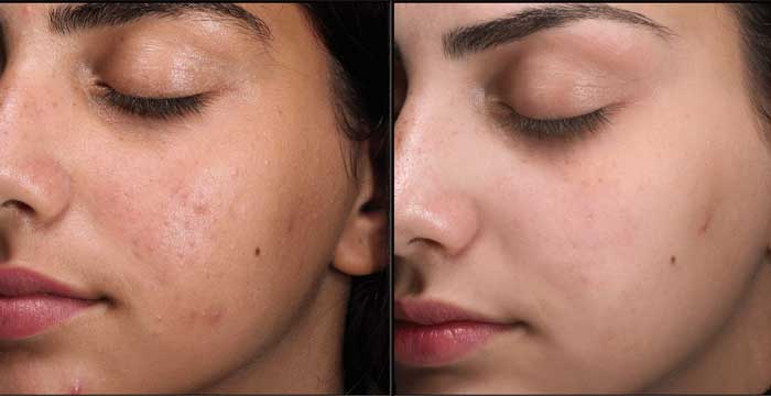 قبل و بعد پوست شفاف
